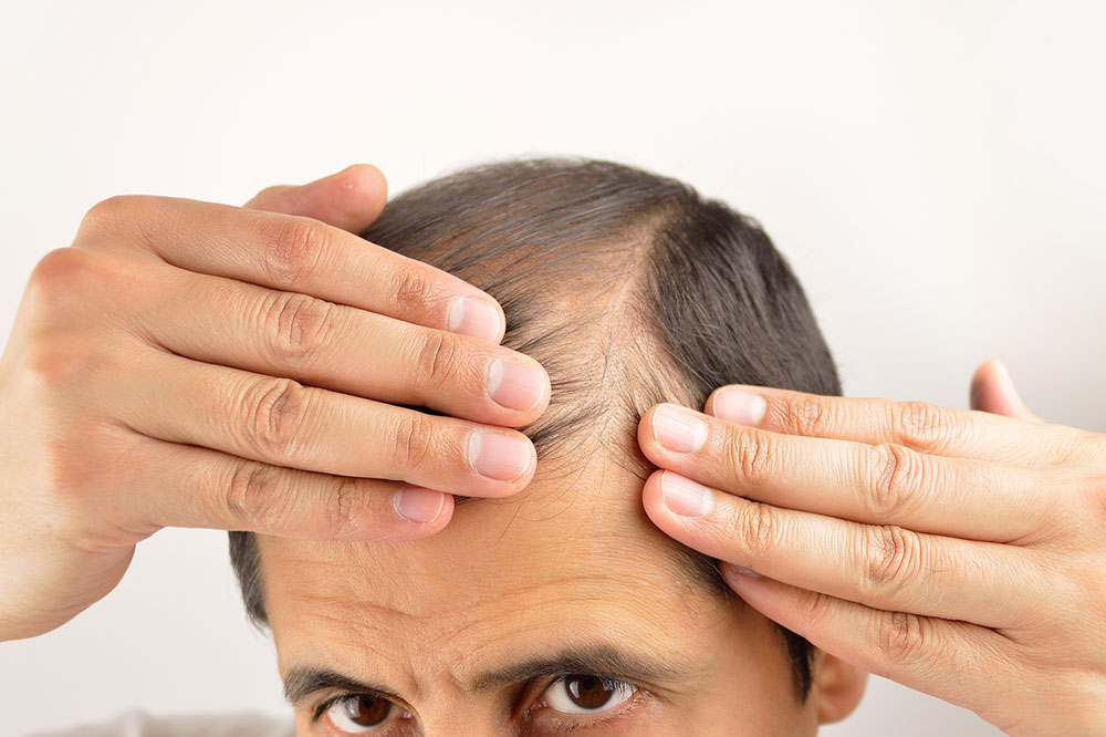 5 Most Effective Home Remedies for Hair Loss