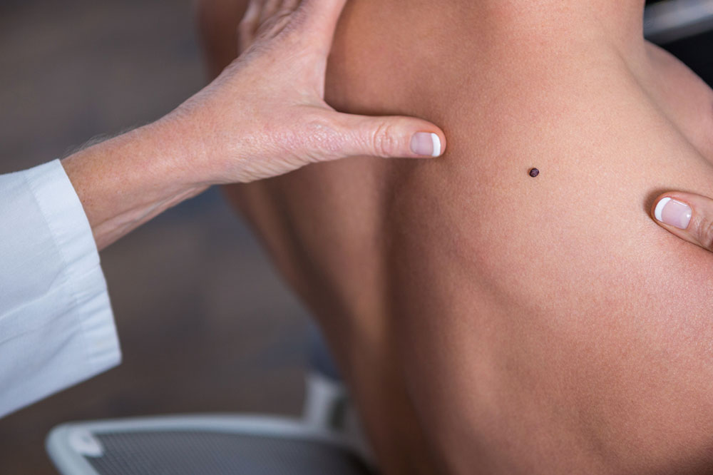 A Comprehensive Guide to Melanoma