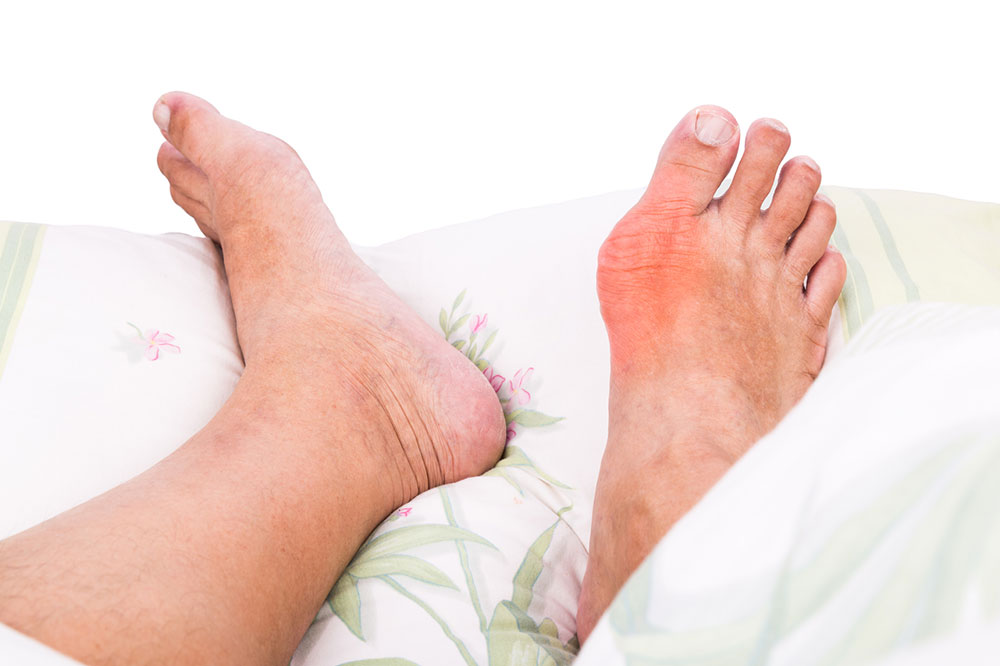 How to Ease a Gout Attack – 7 Natural Remedies That Work